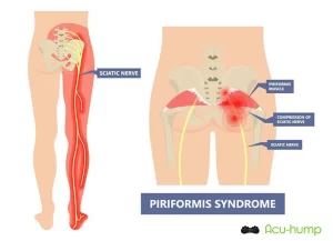Tight piriformis compresses sciatic nerve causing pain