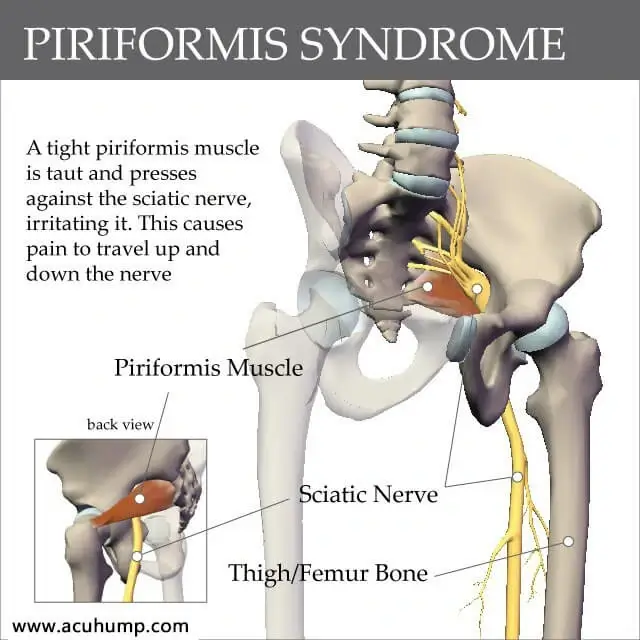 A tight piriformis muscle compresses the sciatic nerve, causing piriformis syndrome