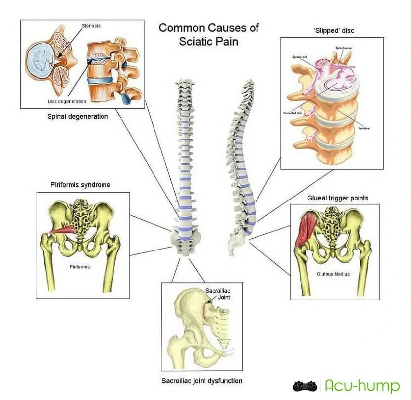 5 Causes of Sciatica Pain