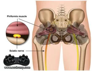 Acu-hump deeply massages the piriformis muscle to relieve compressed sciatica