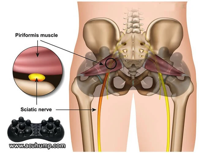 Revealed diagram of Acu-hump pressing on the piriformis muscle to release tight gluteal muscles and compression of the sciatic nerve