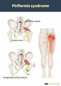 Compression of the sciatic nerve by the piriformis muscle causes piriformis syndrome