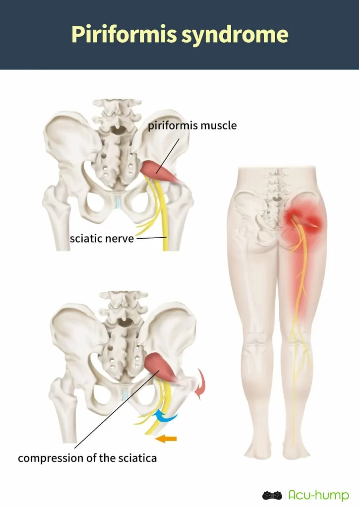 Compression of the sciatic nerve by the piriformis muscle causes piriformis syndrome
