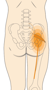 Piriformis syndrome is sciatica that occurs deep in the buttocks