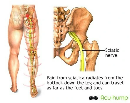 pain from sciatica radiates from the buttock down the leg and can travel as far as the feet and toes