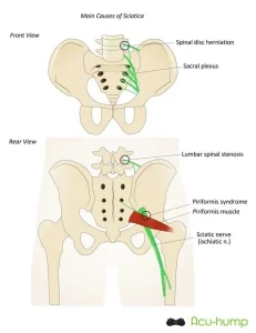 The sciatic nerve runs from the lumbar spine through the pelvis and piriformis muscle to the leg