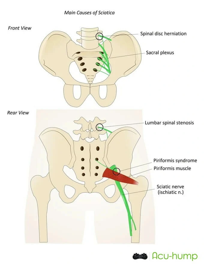 sciatic nerve pain from spinal disc herniation and piriformis syndrome