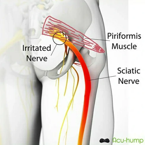 piriformis compresses sciatic nerve