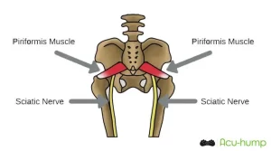 Piriformis syndrome is compression of the sciatic nerve by the piriformis muscle