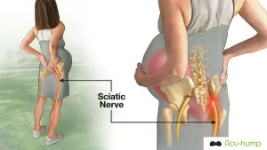Pregnant women deform the pelvis due to hormones and the fetus, causing the piriformis muscle in the buttocks to compress the sciatic nerve, eventually leading to piriformis syndrome