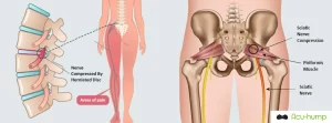 Sciatica starts in the lower back, passes through the piriformis muscle, and extends to the leg. When the piriformis muscle compresses the sciatica, it can cause leg numbness