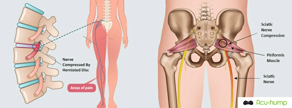 The sciatic nerve is compressed by the spine and the piriformis muscle, leading to pain in the lower back, buttocks, and legs