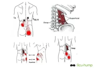 Acu-hump relieves pain from lower back to hip due to QLmuscle radiation