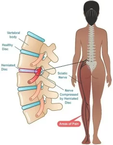 herniated disc causing sciatica in a woman