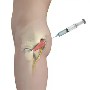 piriformis muscle steroid injection