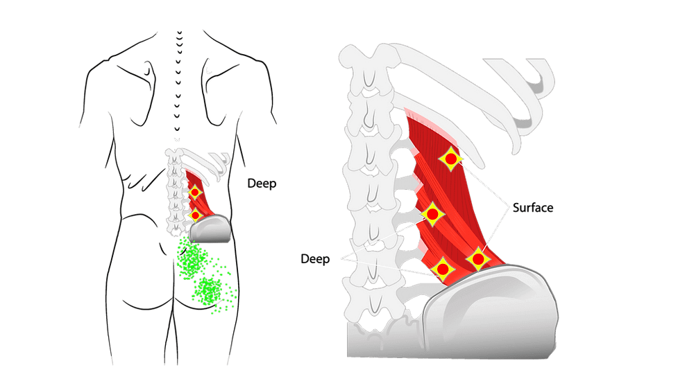 ql muscles lower back cause piriformis syndrome