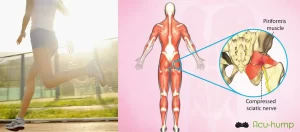 running with piriformis syndrome