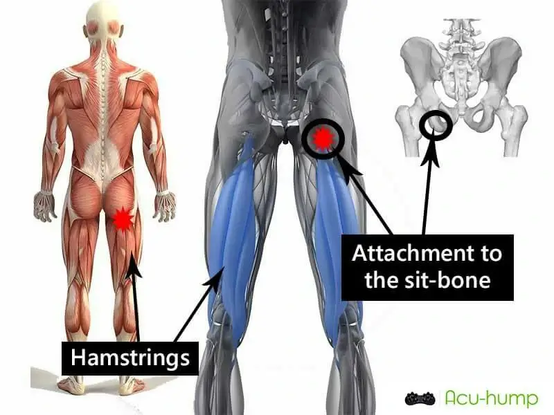 high hamstrings tendinopathy painful areas