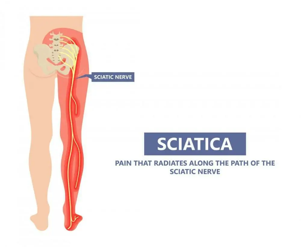 sciatica radiating pain that travels from the lower back down to the legs.