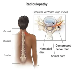Lumbar Radiculopathy