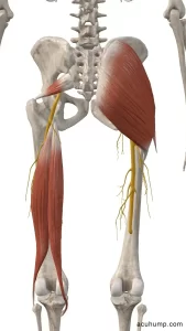 trapped sciatic nerve in the buttocks